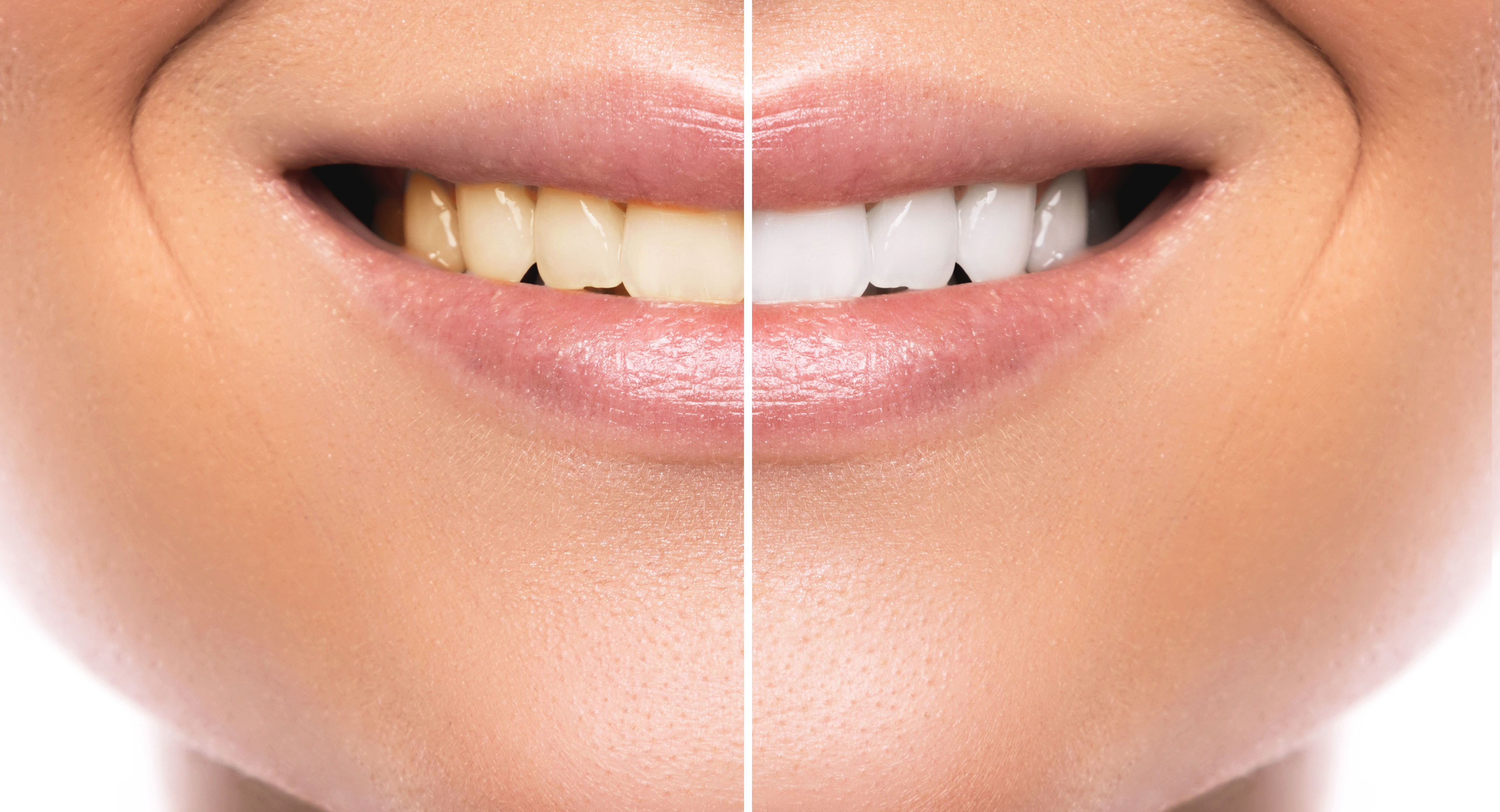 How Does Professional Teeth Whitening Work? | Celina, TX