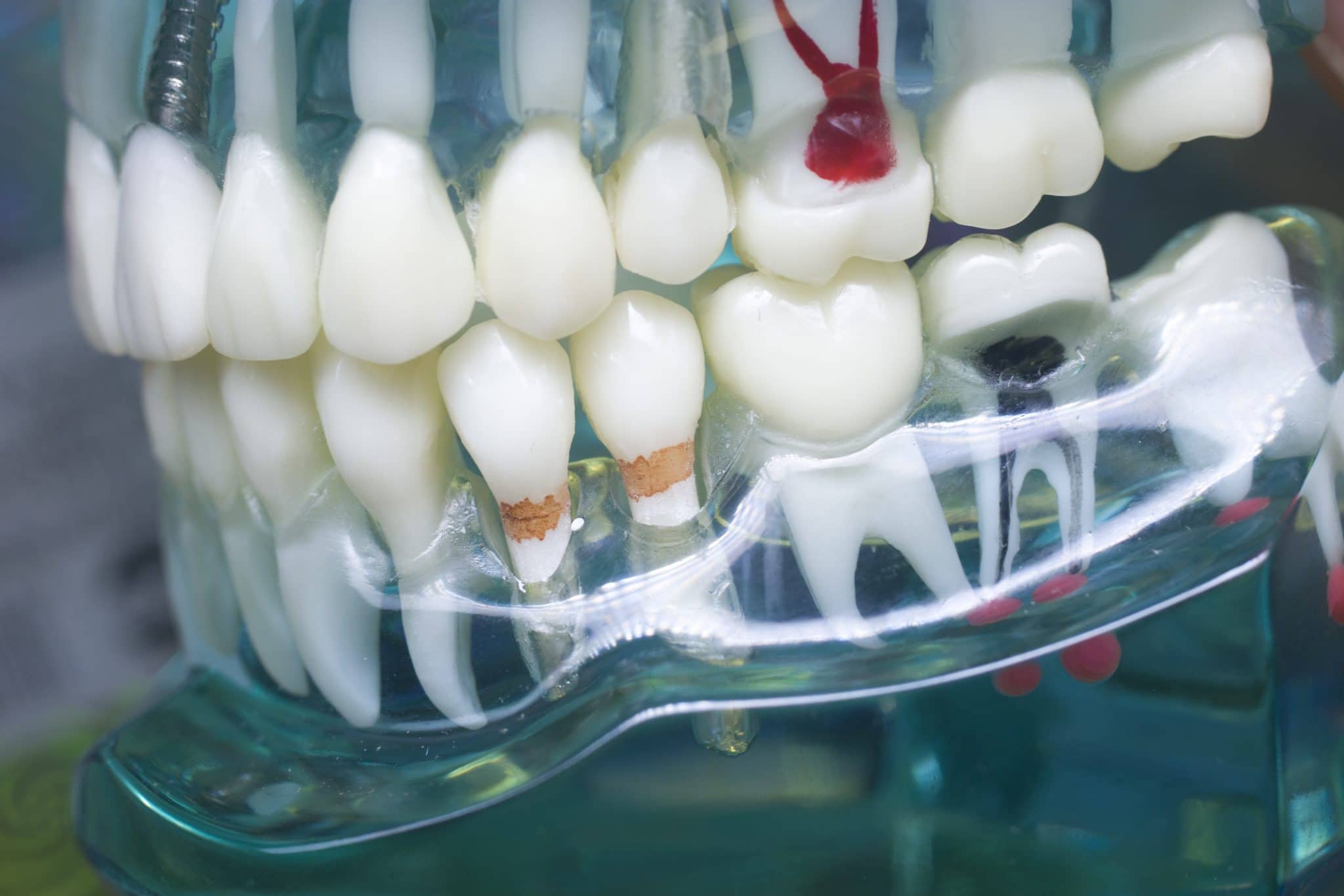 Celina Dentist Relieves Discomfort With Root Canal Therapy ...
