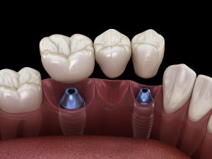 dental bridge