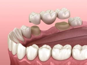 dental bridge