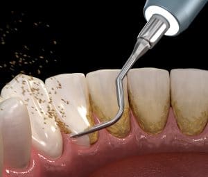 Oral hygiene: Ultrasonic teeth cleaning machine removing calculus and plaque. Medically accurate 3D illustration of human teeth treatment