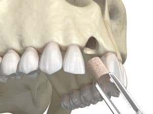 celina jawbone grafting