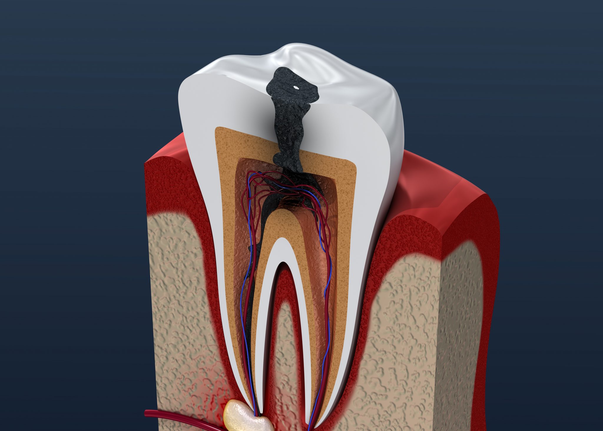 Celina Dentist Safeguards Smiles With SDF | Celina, TX