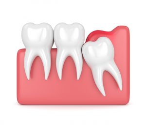 celina wisdom tooth