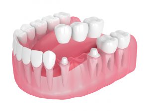 celina dental bridge