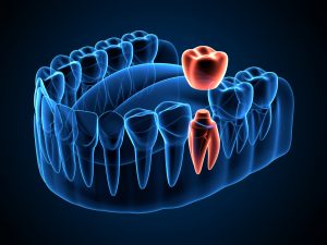 celina dental crown