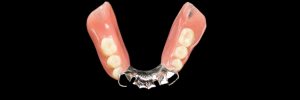 celina partial dentures