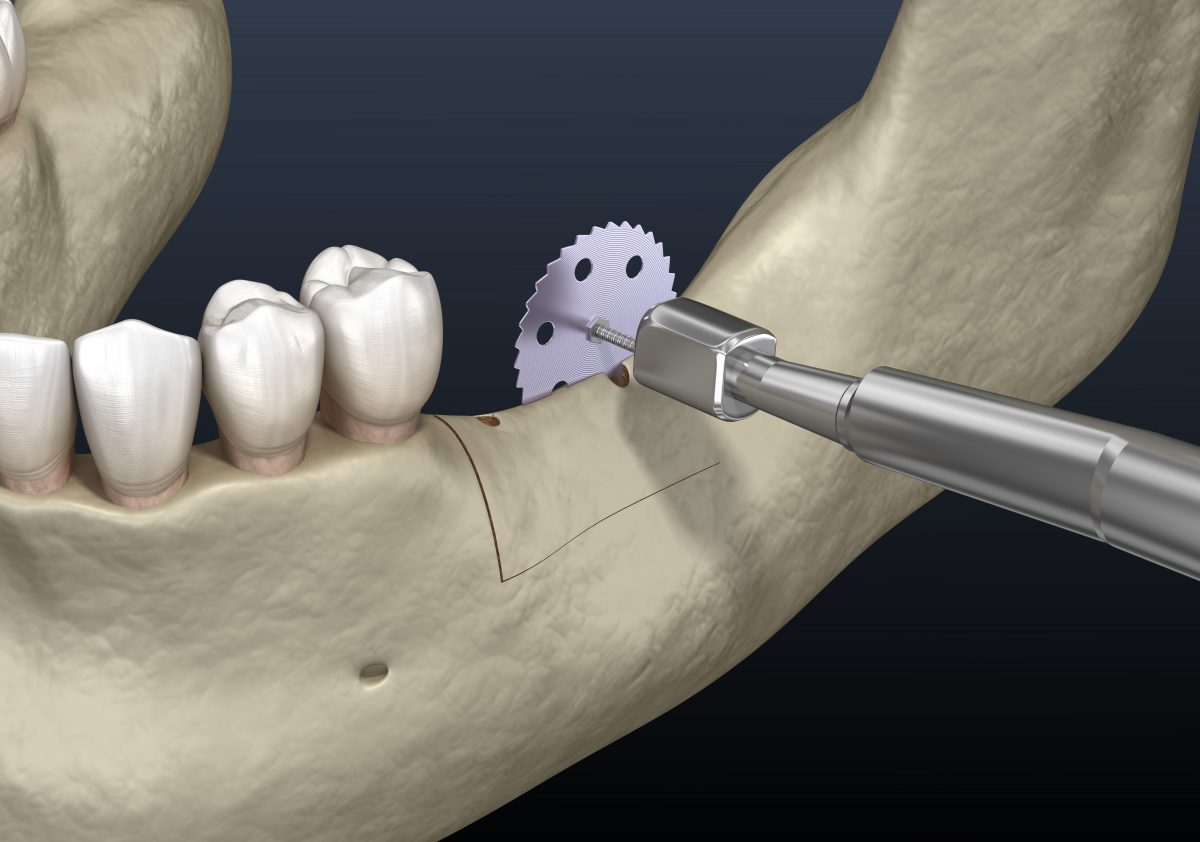 Restoring Smiles With Jawbone Grafting Celina Tx