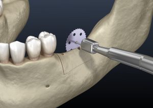 celina bone grafting