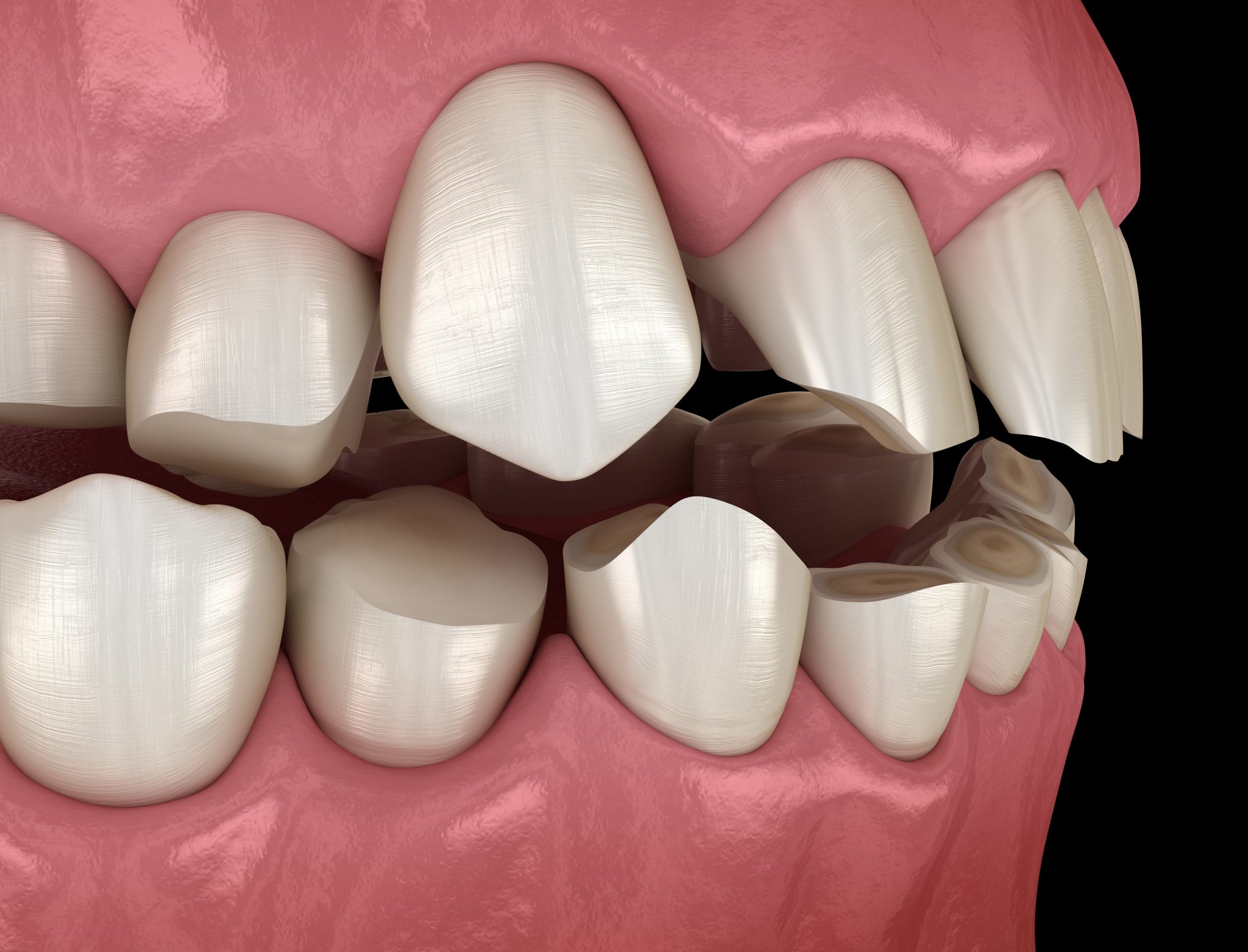 A Customized Solution To Teeth Grinding Celina, TX
