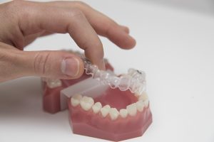 celina clear braces