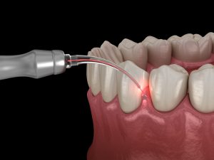 celina laser gum contouring