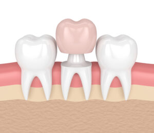 celina dental crowns
