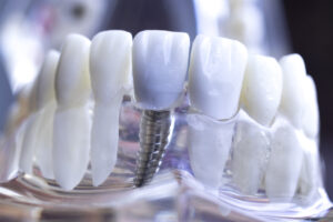 celina dental implants same day