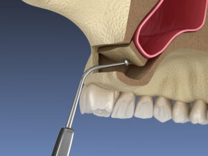 celina bone grafting