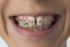 celina orthodontic treatment