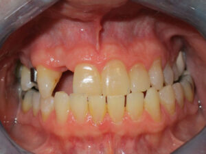 Mini implant (Before)