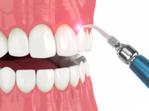 celina dental lasers