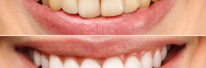 celina teeth whitening options