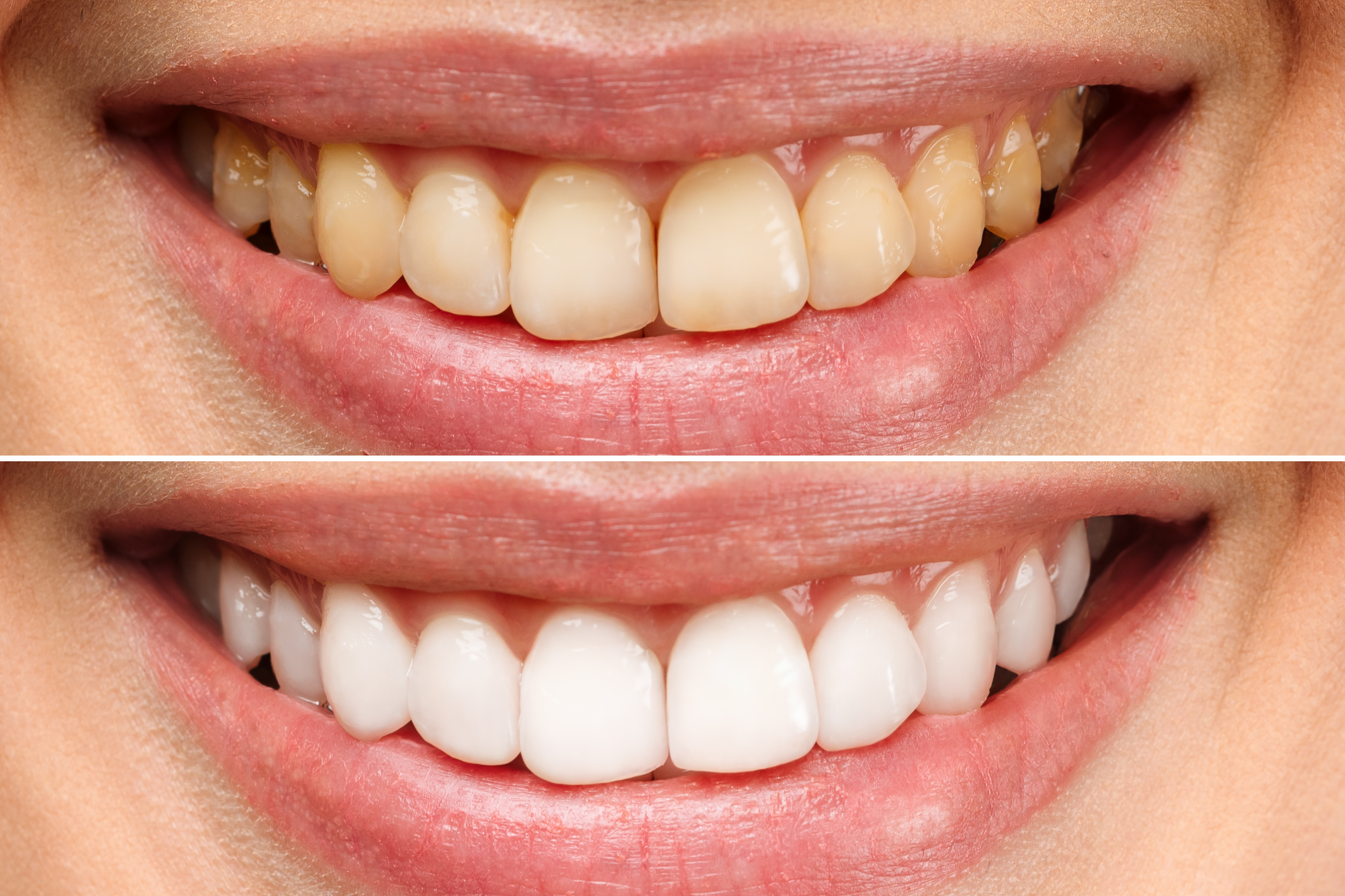 Whitening Brightens Smiles By Several Shades Celina TX   Celina Teeth Whitening 