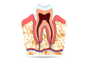 celina root canal treatment