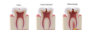 celina root canal