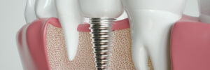 celina dental implants