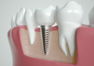 celina dental implants