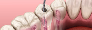 celina root canal