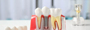 celina dental implants