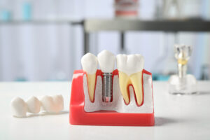 celina dental implants