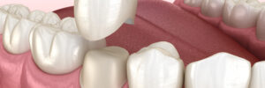 celina dental crown