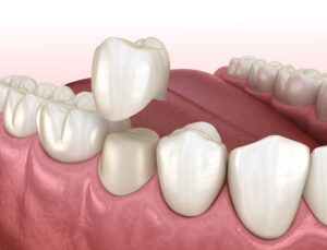 celina dental crown