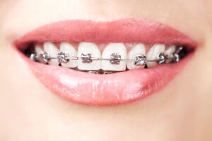 celina orthodontics