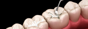 Molar tooth fissure restoration with filling. Medically accurate tooth 3D illustration.