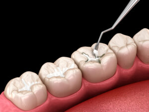 Molar tooth fissure restoration with filling. Medically accurate tooth 3D illustration.