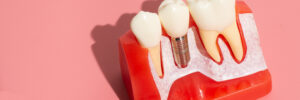 celina dental implants