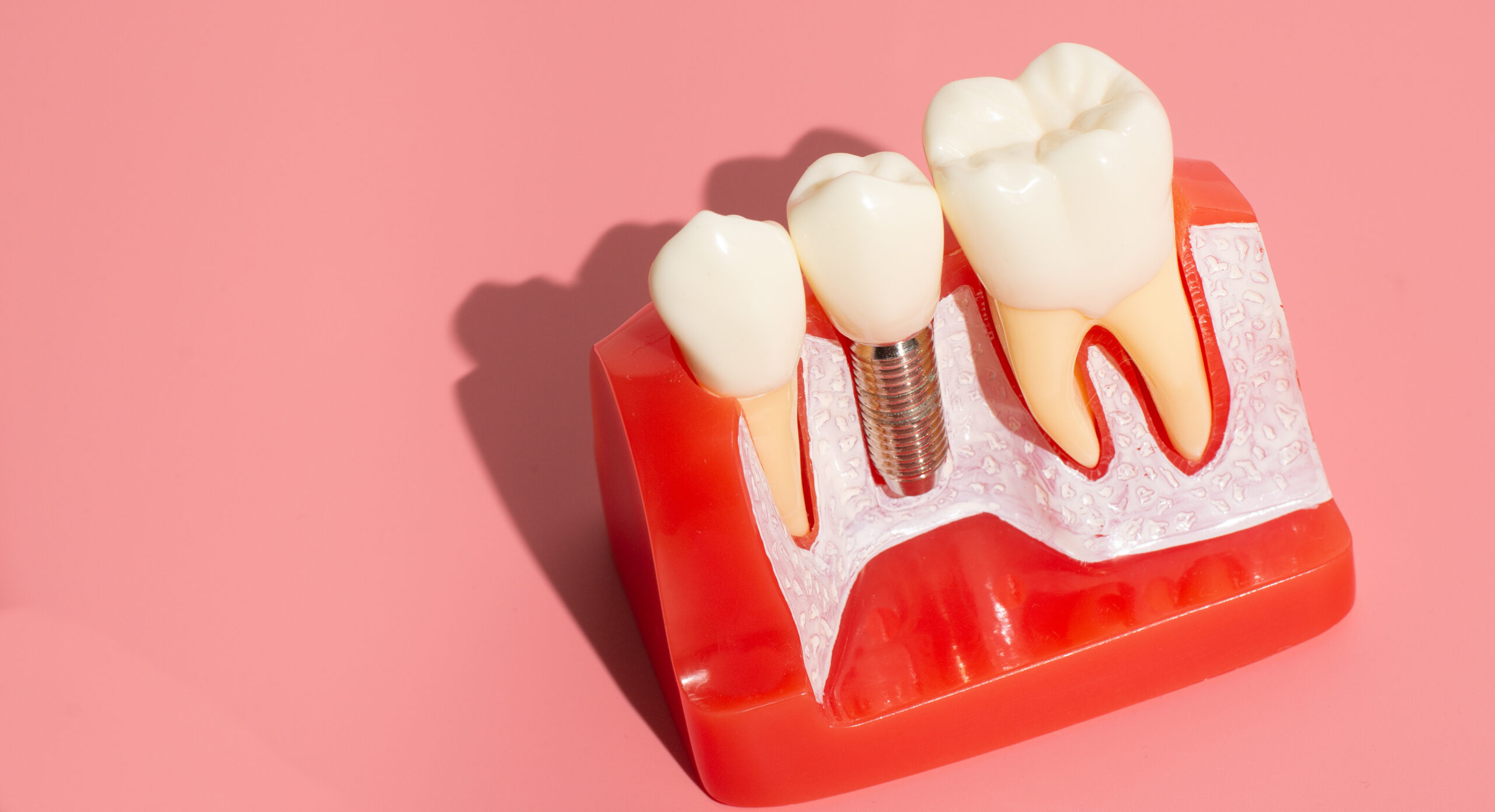 Implant Dentistry Offers A Full Smile Celina, TX