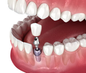 celina dental implant