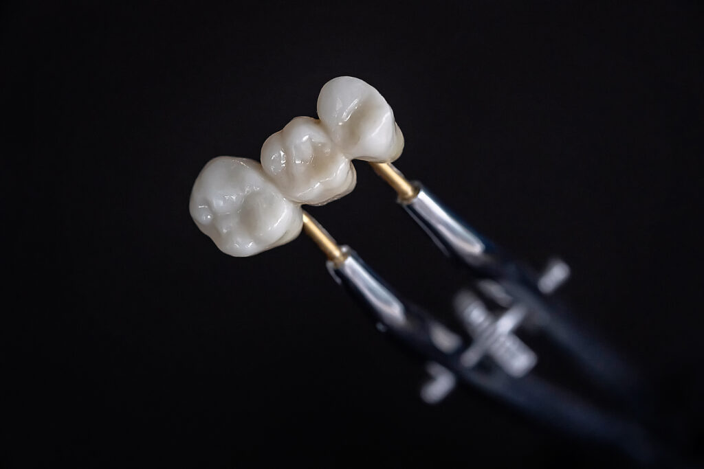 celina dental bridge