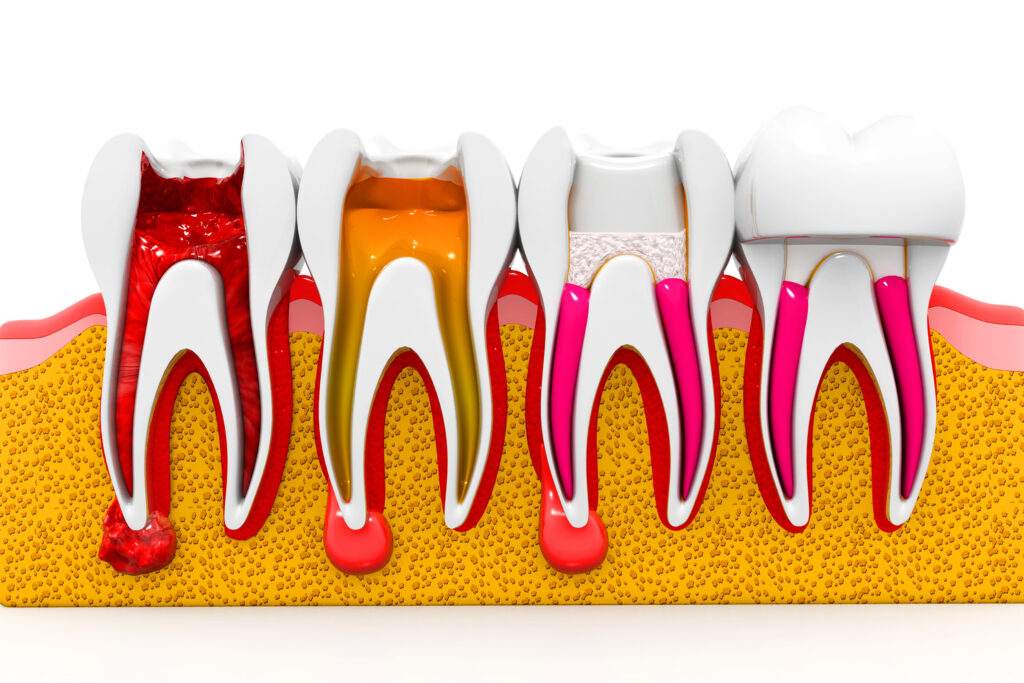celina root canal