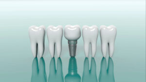 celina dental implants
