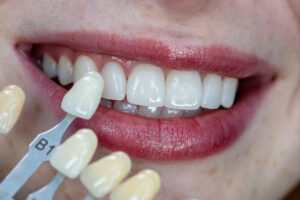 celina dental restoration