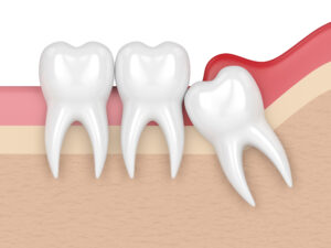 celina wisdom tooth extraction