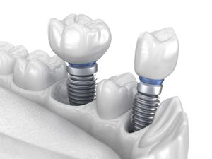 celina dental implants
