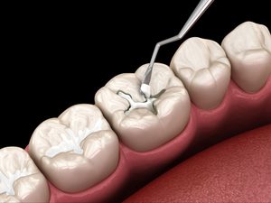 celina dental filling