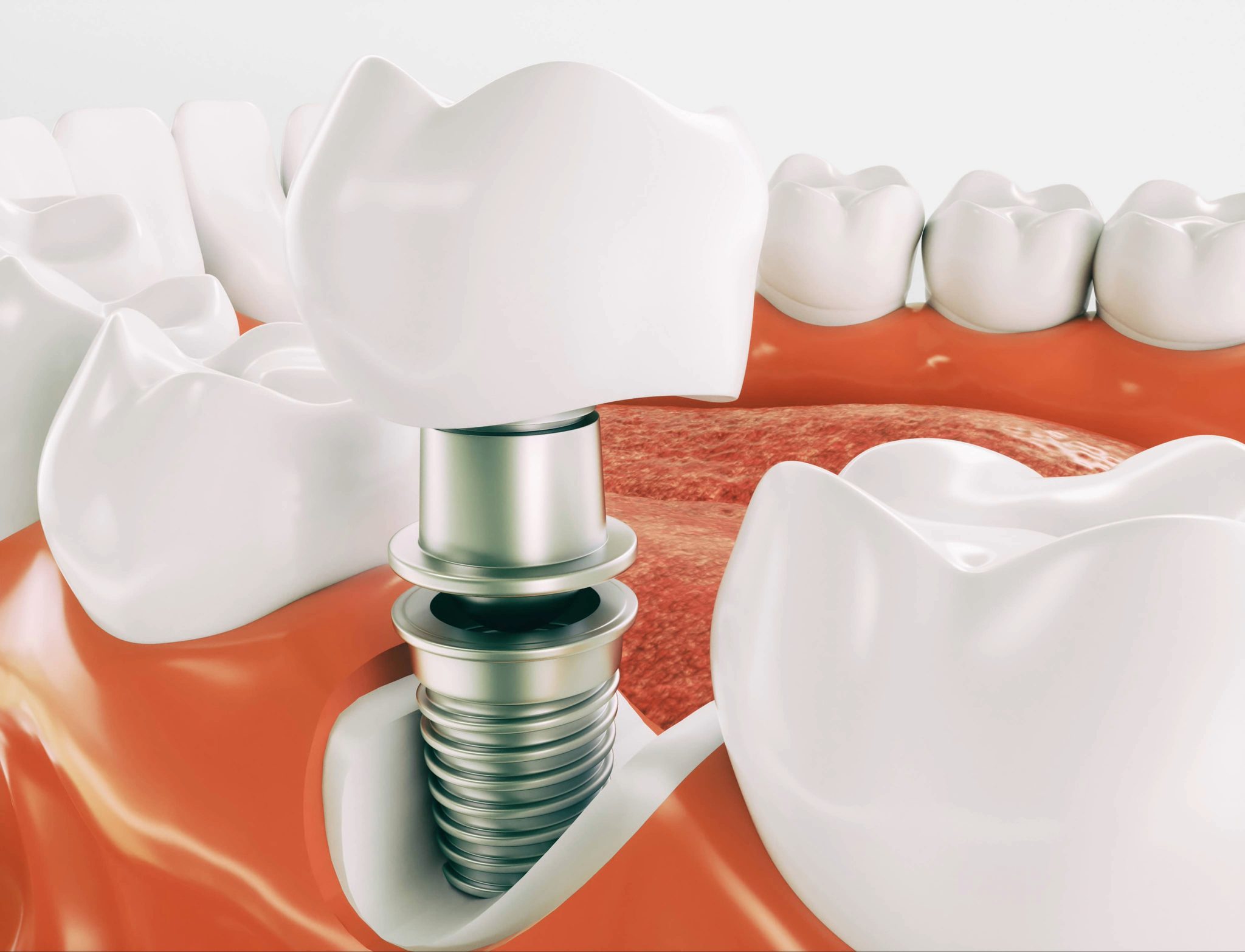 Wisdom Teeth Issues Oral Surgery Takes On Serious Issues - Celina Family Dentistry