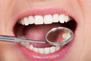 two important benefits of tooth-colored fillings