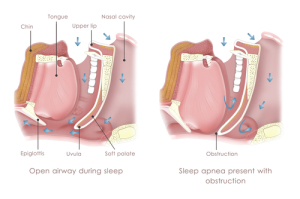 sleepapnea